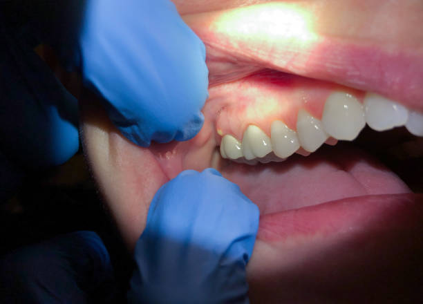 Best Emergency Tooth Extraction in Greenfield, MN